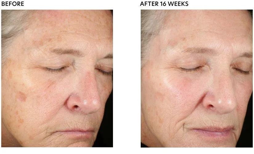 PCA Skin Pigment Gel® Pro