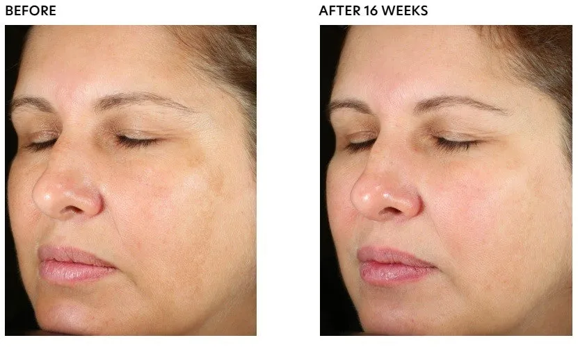 PCA Skin Pigment Gel® Pro